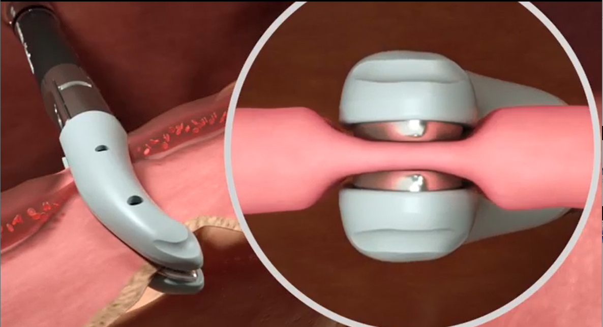 高频电刀，超声刀，LigaSure血管闭合系统的区别和对比